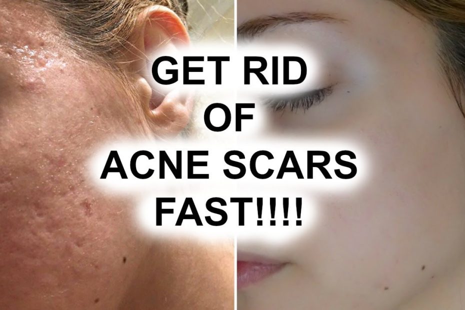 How To Get Rid Of Acne Scars || Pershii - Youtube